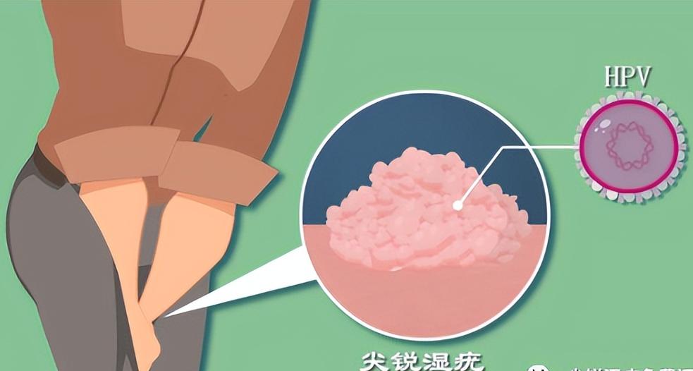 尖锐性湿疣多久不复发算康复了,尖锐性湿疣多久不复发算好了