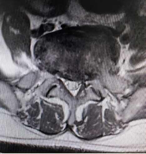 门医技术|门头沟区医院骨二科成功应用微创椎间孔镜技术治疗两例腰椎管多节段狭窄症