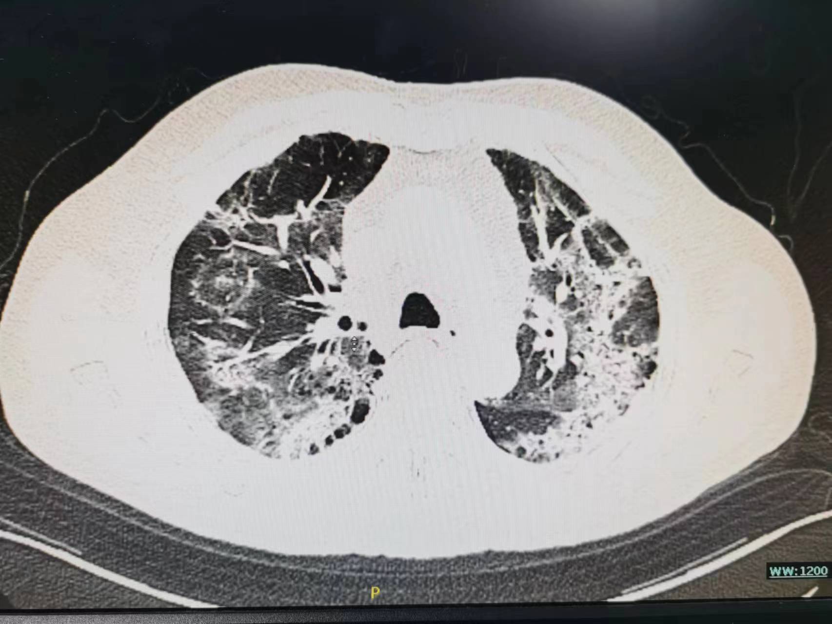 老年人发低热不退是什么原因,老年人阳了一直咳嗽怎么办