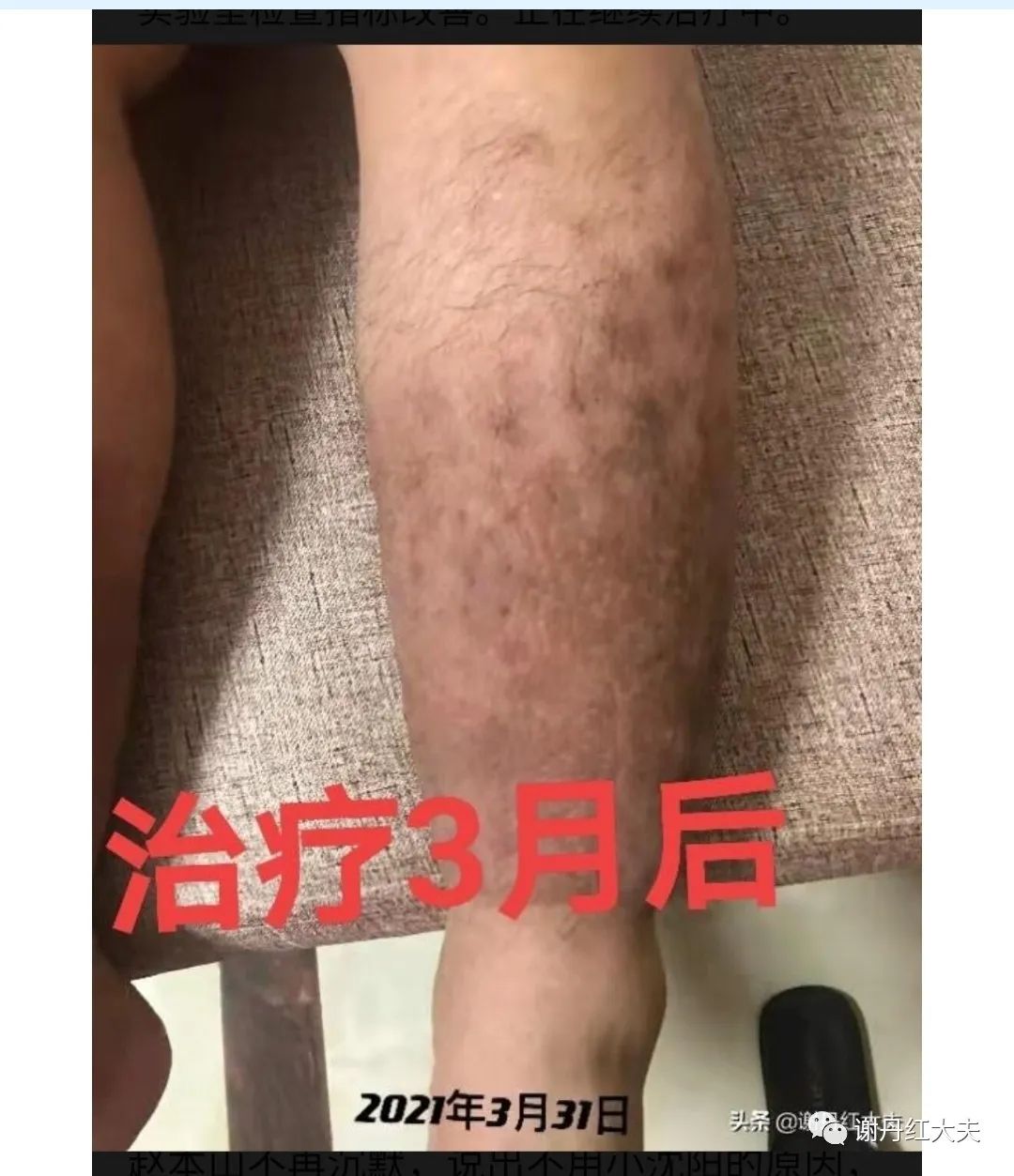 胫前黏液性水肿见于哪些病,胫前黏液性水肿为凹陷性水肿吗