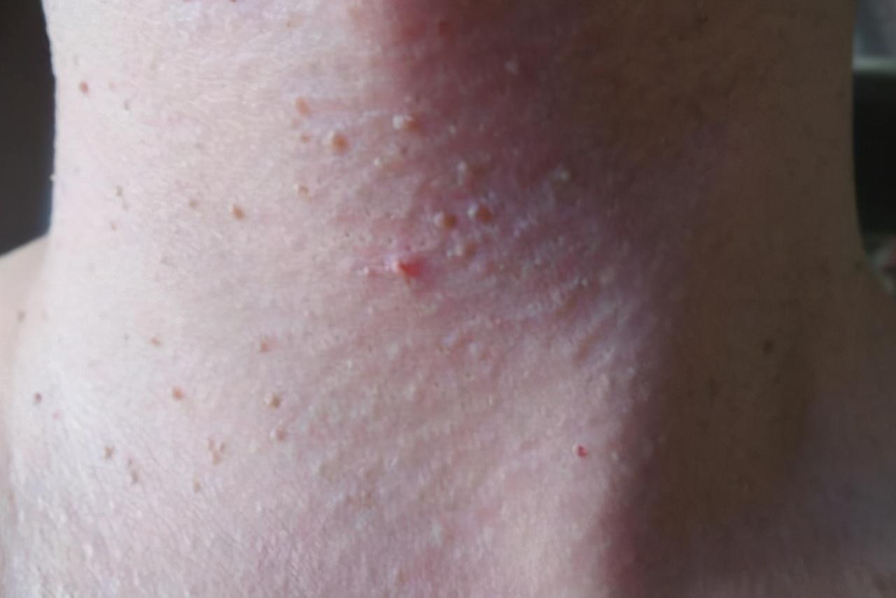 脖子和腋下的小肉粒是什么,脖子和腋下有小肉粒用什么药涂