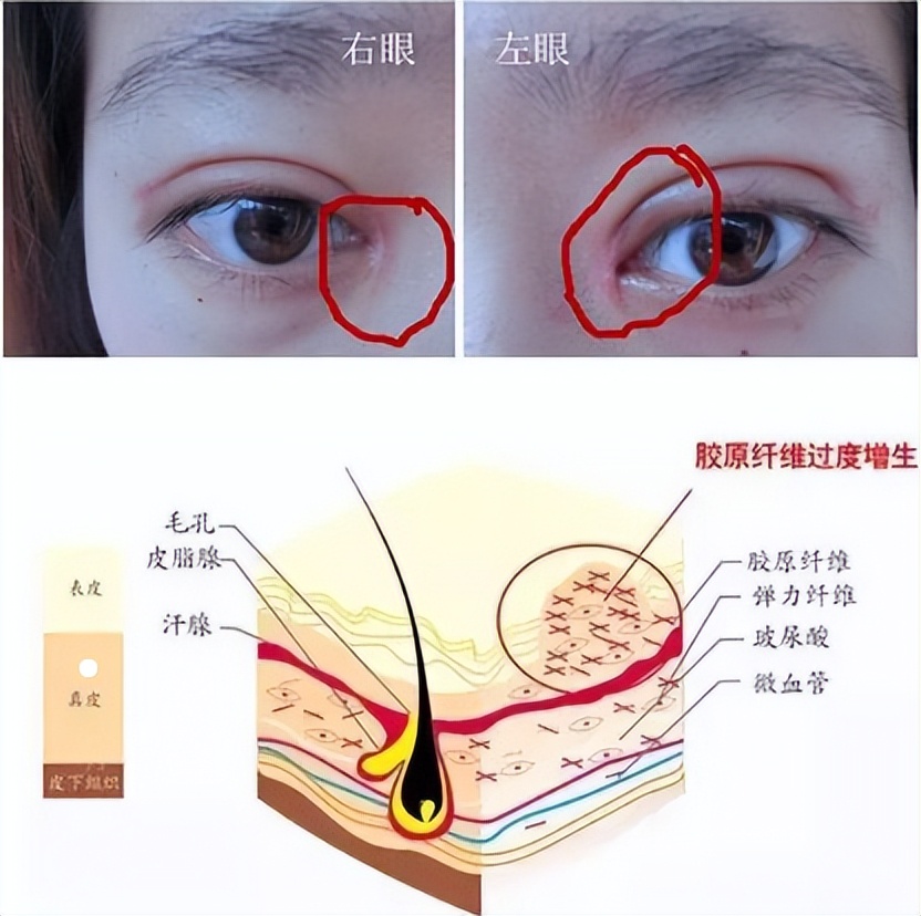 太原丽都整形医院割双眼皮好不好,太原割双眼皮正规整形医院