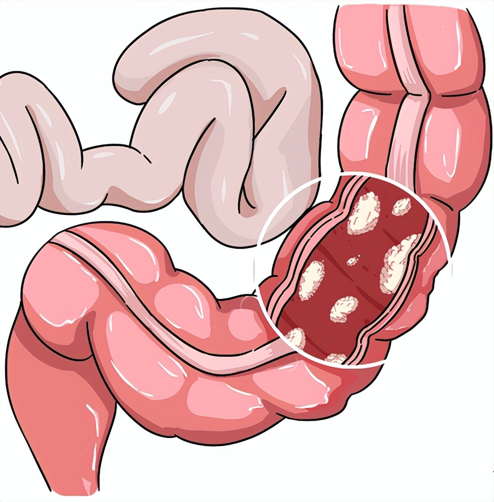 我亲身经历的胃肠镜检查及治疗,做了无痛胃肠镜应注意什么