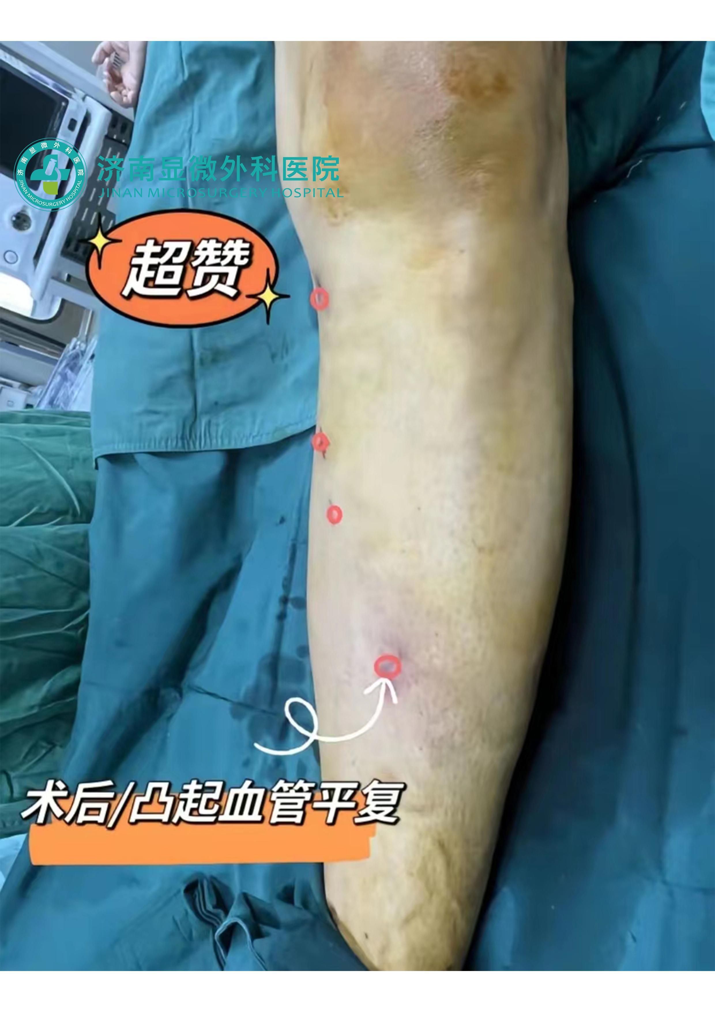 微创治疗下肢静脉曲张有几种方法,下肢静脉曲张微创治疗效果如何