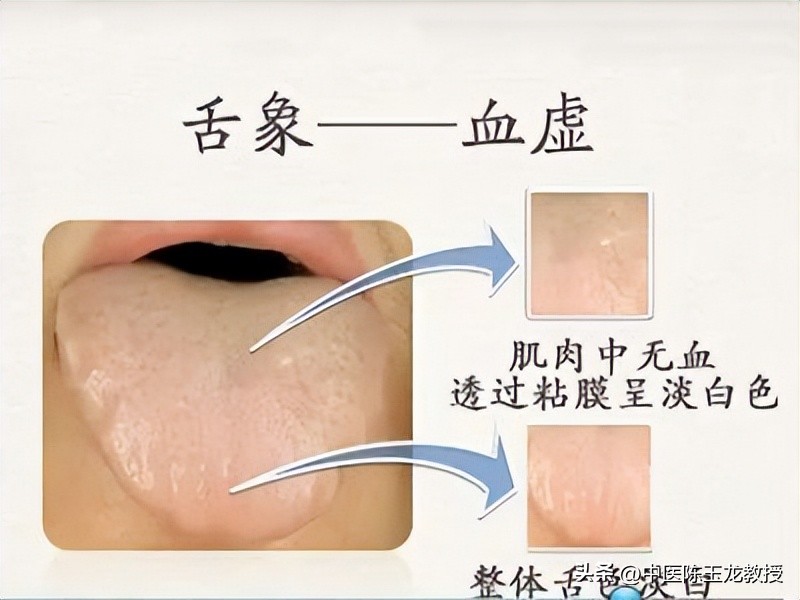 痛经特效方剂,当归四逆汤治冻疮疼痛案例