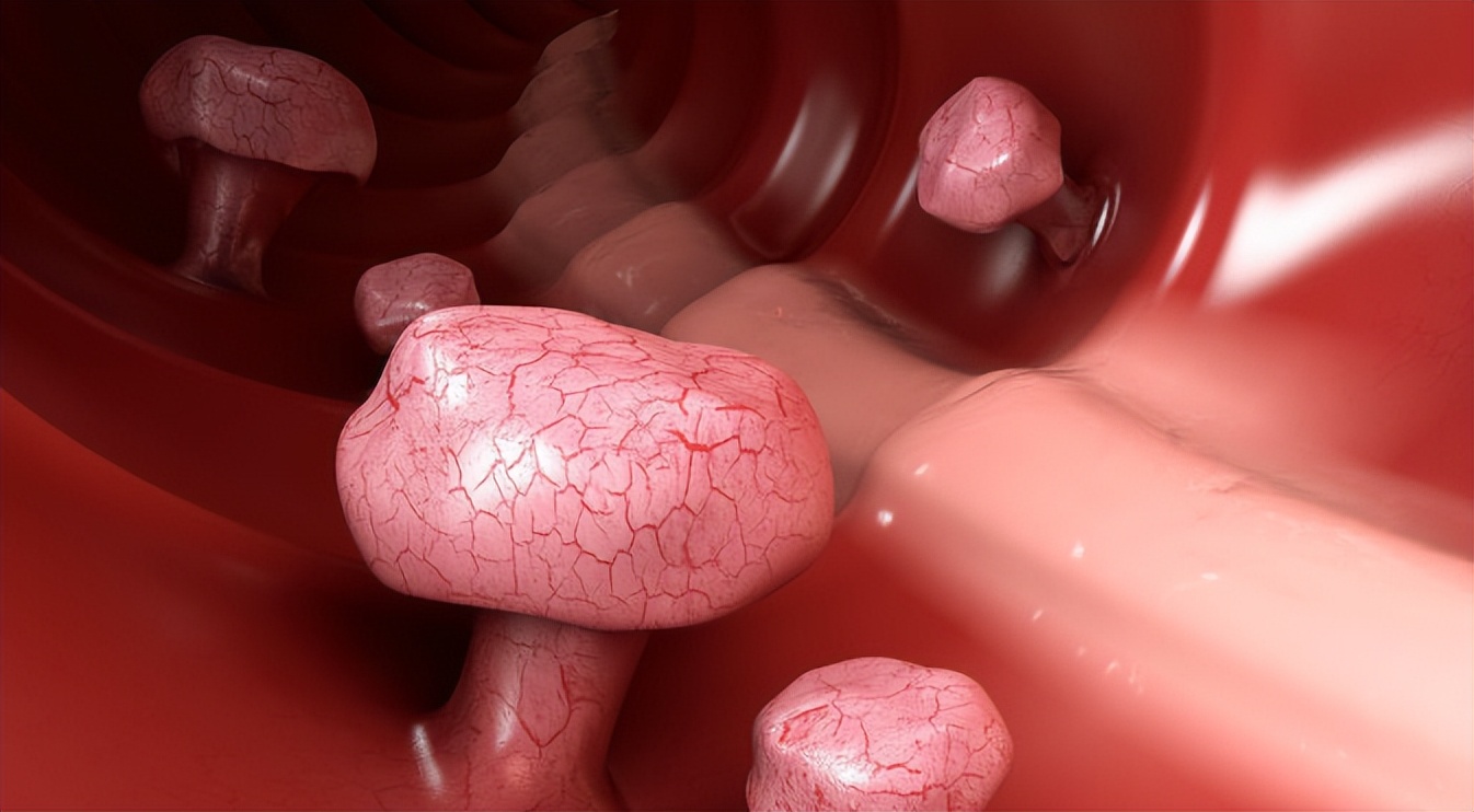 肠道多发息肉还是单发息肉严重,肠道扁平息肉厉害还是息肉厉害