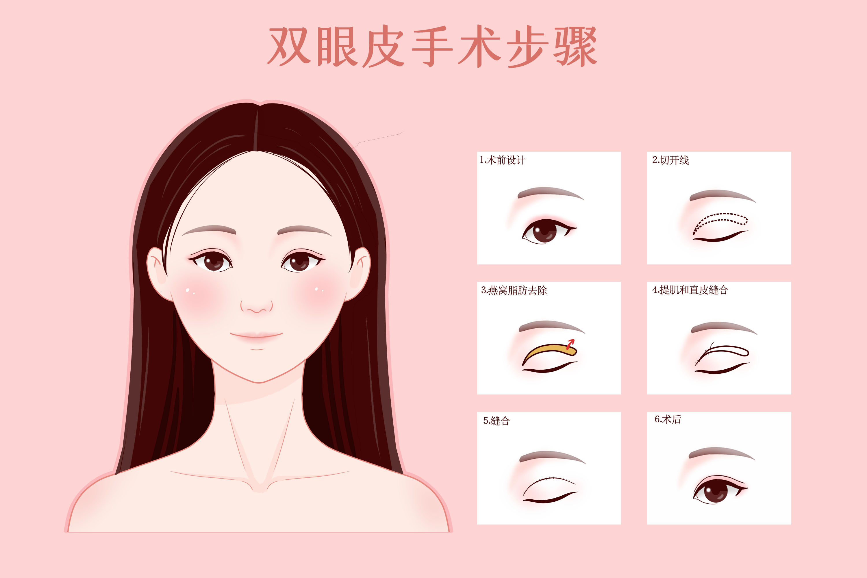 69岁老年割双眼皮失败,双眼皮割的前宽尾窄是不是失败了