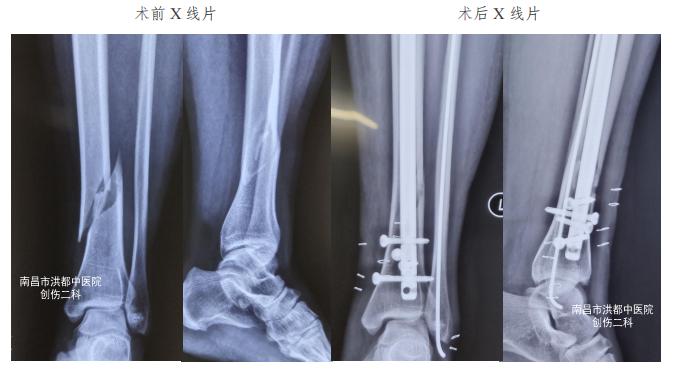 女子滑倒致小腿骨折，医生巧术让患者“快速复位”