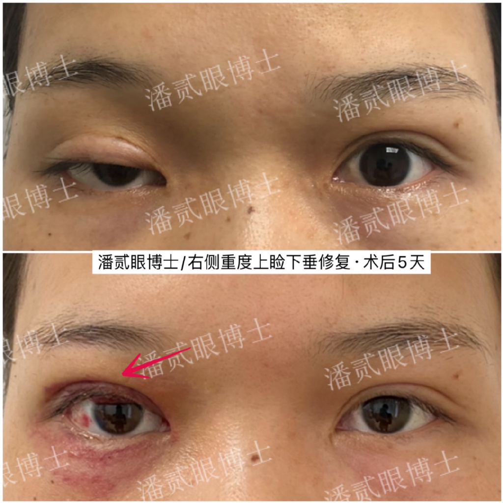 术后（重度上睑下垂）出现结膜脱垂怎么办？