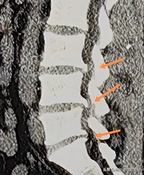 腰椎盘突出臀骨与大腿连接处疼痛,腰间盘突出臀部疼痛脚麻怎么治疗