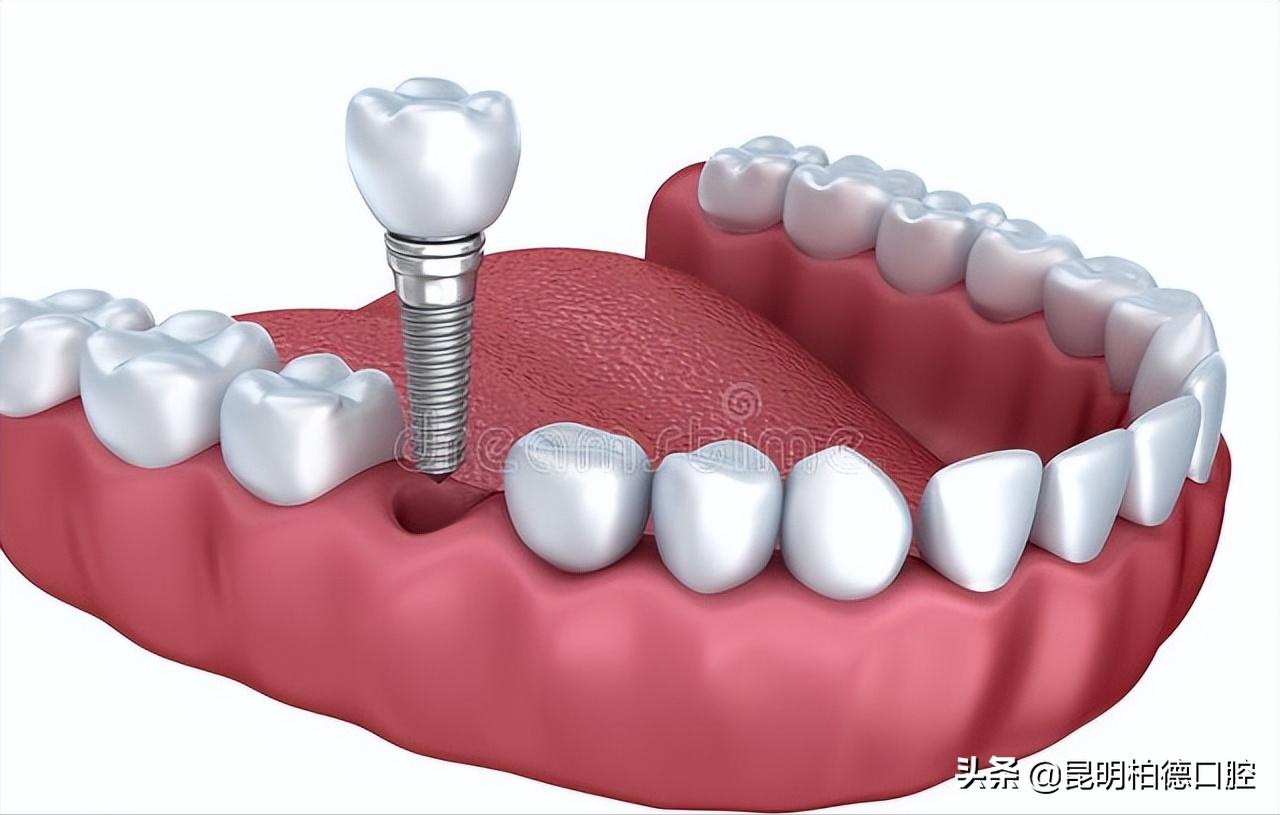 牙齿缺了10年现在还可以种植牙吗,满牙齿都烂了怎么才能种植牙