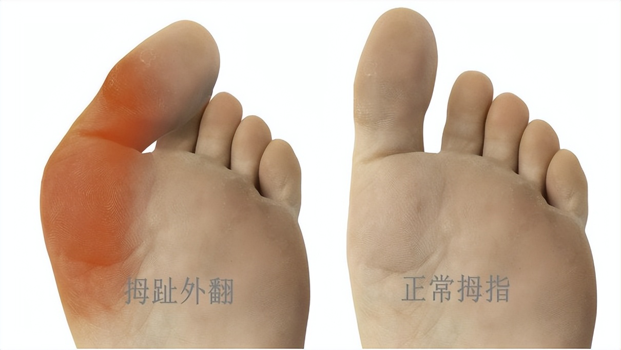 大拇脚趾往里歪怎么矫正,严重拇外翻脚趾畸形怎么办