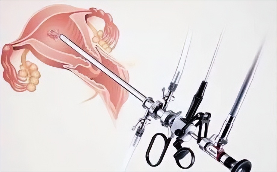 无X生活也能不损伤CN膜切除子宫内膜息肉？