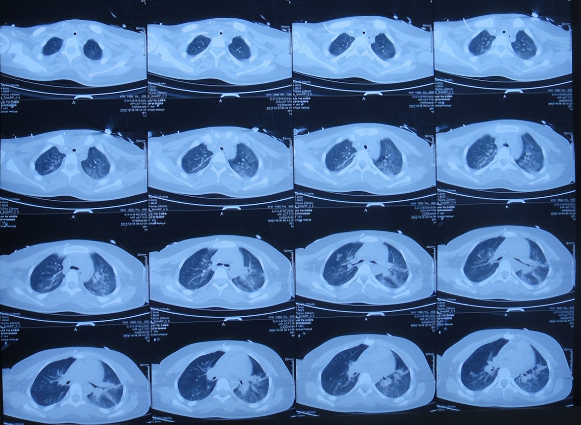 脑干出血儿童,儿童脑干胶质瘤呕吐