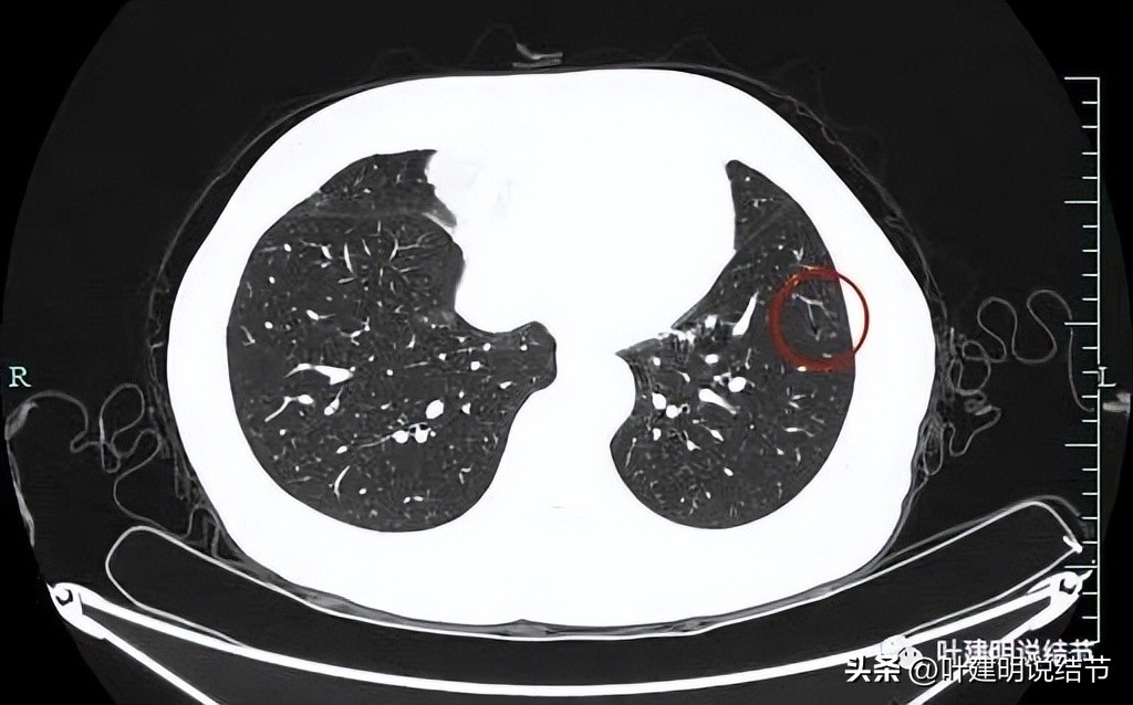 辽宁省肺结节手术哪家医院好,辽宁肺结节手术医院