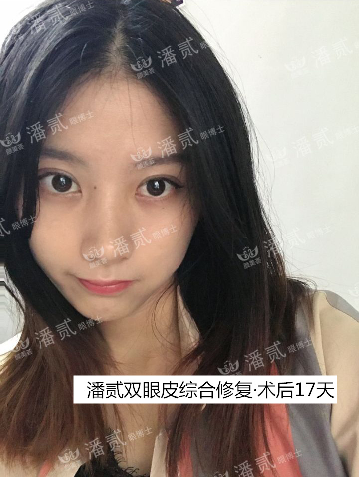 双眼皮贴导致眼皮破了,双眼皮贴导致眼皮严重下垂恢复