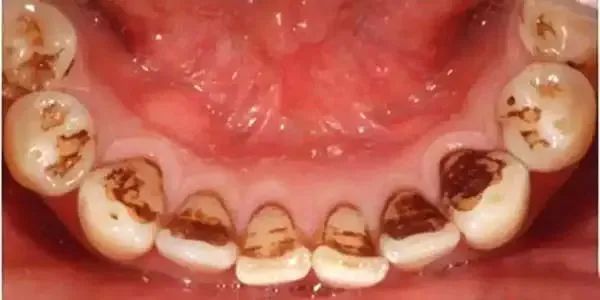 牙齿发黄怎么办快速解决方法,牙齿发黄怎么办最快最有效方法