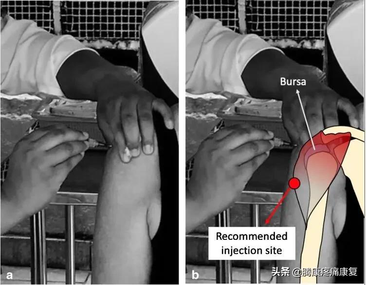 注射疫苗后的肩部疼痛