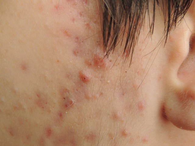 长痘痘怎么内服有用,内服祛痘痘良方