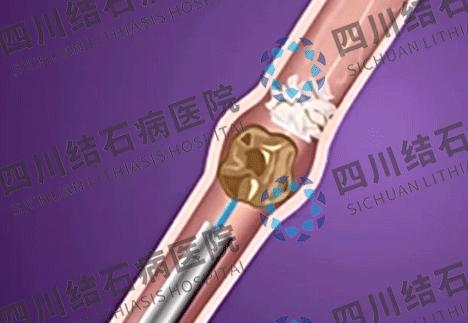 输尿管结石有什么好的治疗方法,得了输尿管结石用什么方法治疗