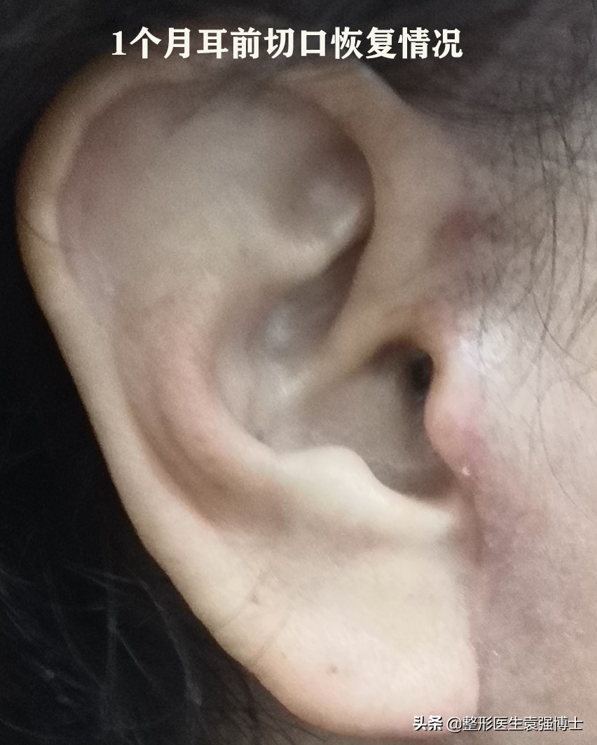 拉皮整形手术失败的案例,拉皮手术导致失败视频