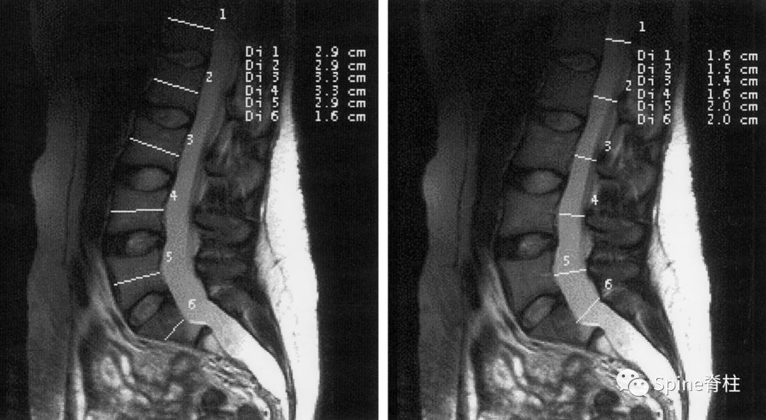 硬膜囊扩张是什么意思,硬膜囊扩张压迫神经