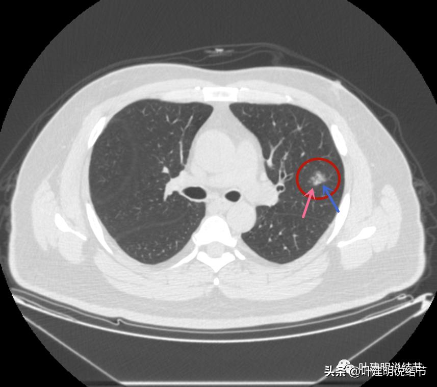 如何判断肺磨玻璃结节是高危结节,肺上有混合磨玻璃结节要注意什么