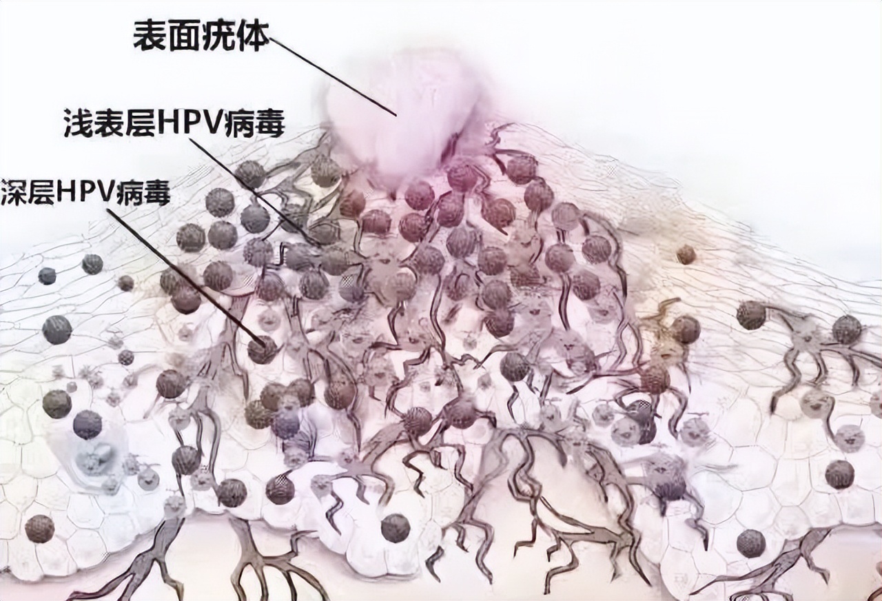 女性感染hpv病毒是丈夫出轨了吗,女性感染hpv病毒是不是老公出轨了