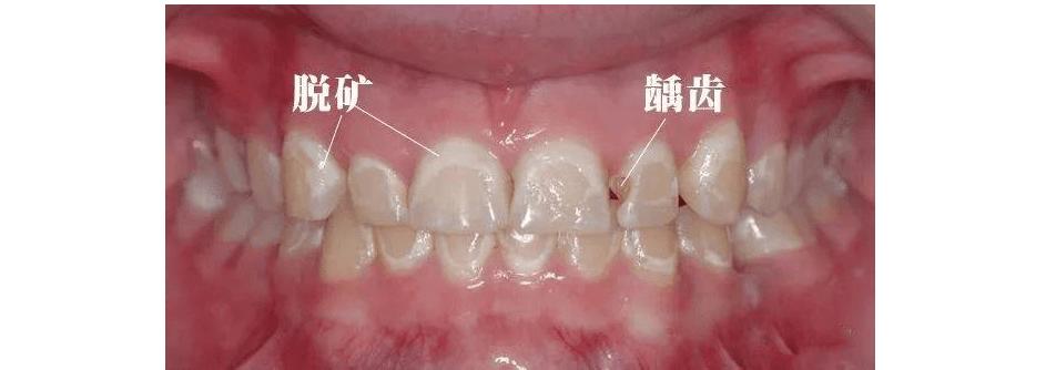 用完牙贴牙齿出现了白斑怎么回事,矫正牙齿期间牙齿出现白斑