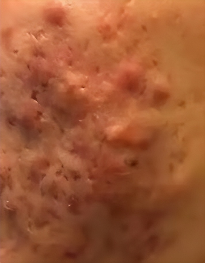 背上长痘痘留下黑色疤痕怎么办,长痘痘后留下的疤痕怎么办