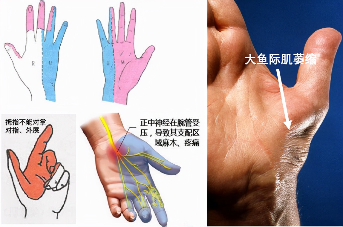 鼠标手手指麻木,鼠标手麻木无力