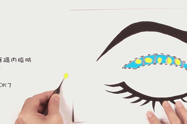 北京切开双眼皮恢复过程,北京双眼皮手术失败案例