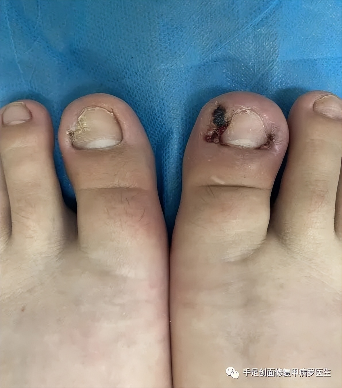 不要等孩子出了问题才重视,孩子得了甲沟炎怎么自己治疗