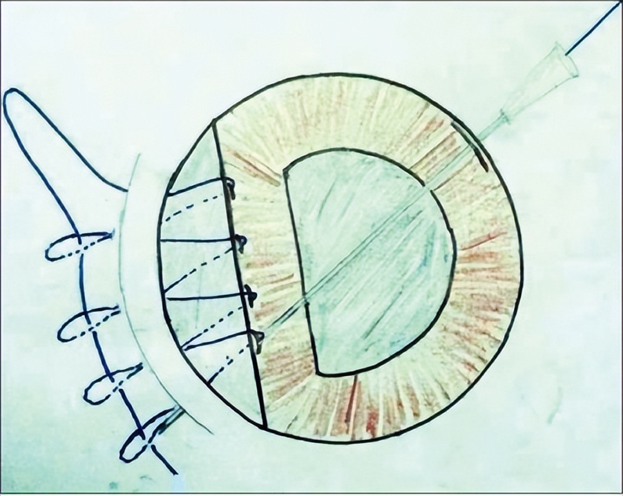 同济大学附属上海东方医院金海鹰教授：巩膜层间缝纫机技术要点