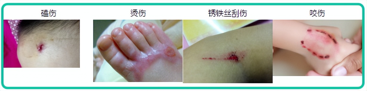 小孩被咬破皮为什么打破伤风针,儿童被大人咬伤要打破伤风针吗