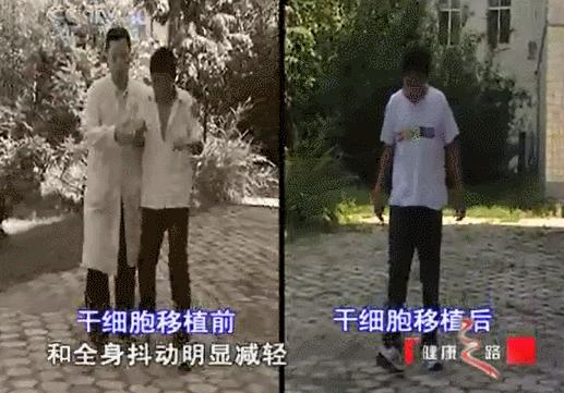 小脑萎缩与干细胞十大神奇功效,干细胞成功治疗了视神经萎缩