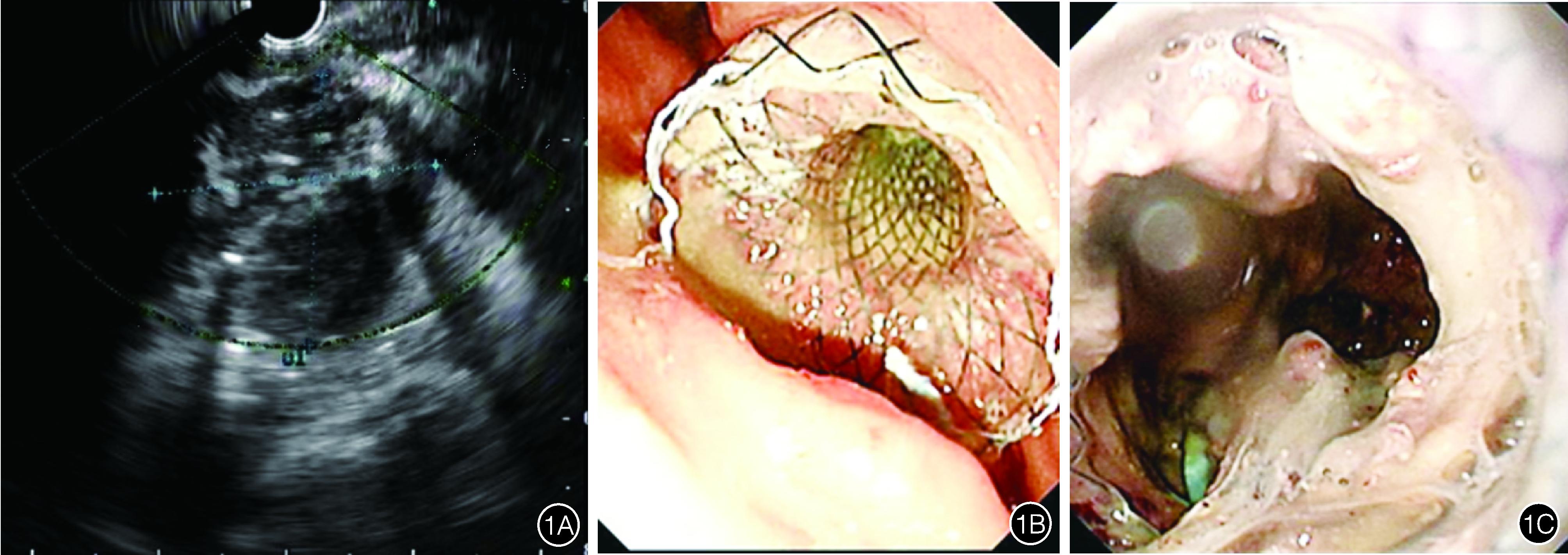 经皮肾镜治疗胰腺炎,内镜下胰腺坏死组织清创引流术