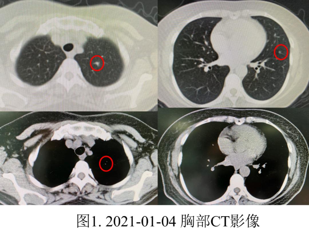 妇女双肺多发结节，病理示炎症，病情持续进展如何揭疑？