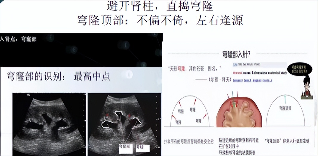 明知山有虎,偏向虎山行——肾斗士VS肾结石