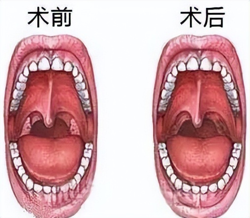 扁桃体为什么老是容易发炎,扁桃体为什么容易发炎