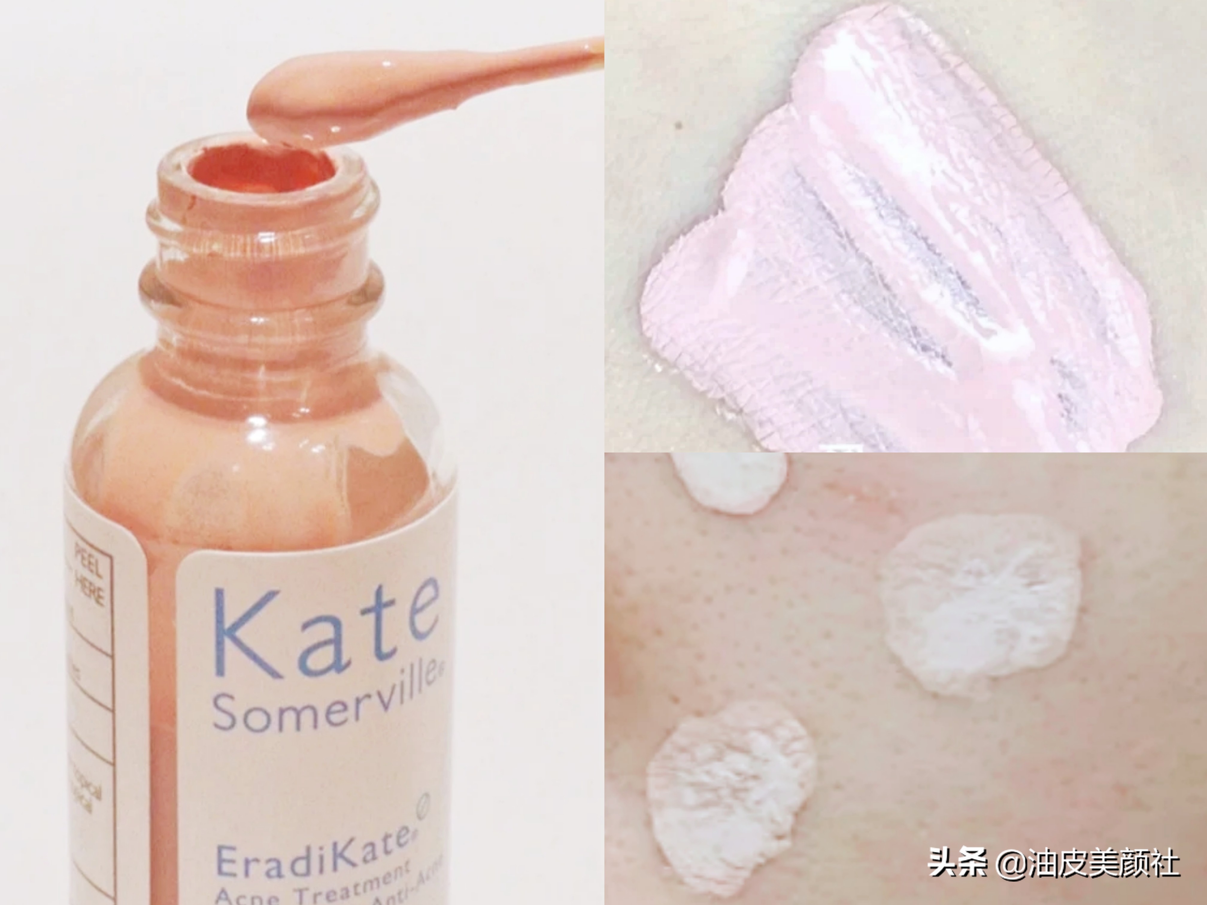 祛痘好物推荐一下,推荐十款实用的祛痘产品