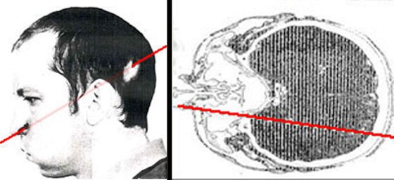 大脑被质子流穿过！他保住了性命，多年过去左脸依旧年轻