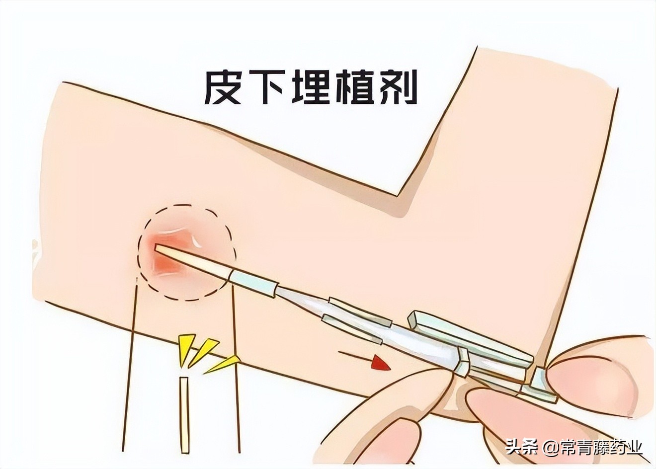 皮埋避孕的优点和缺点是什么,皮埋避孕所有人都能做吗