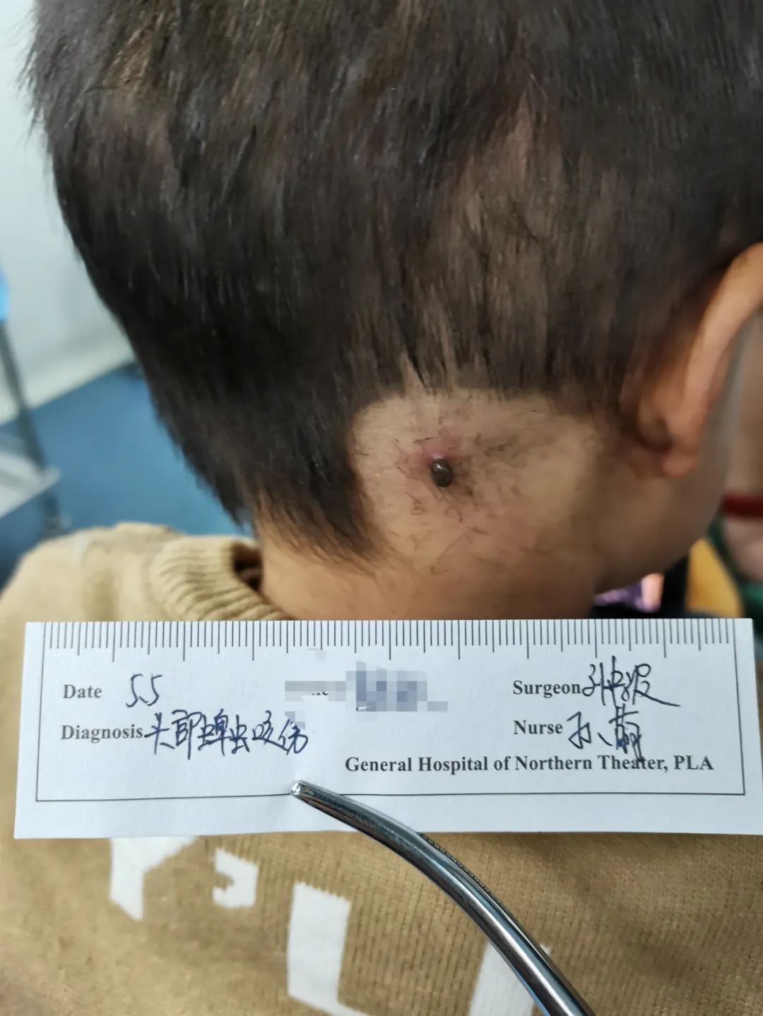 被蜱虫咬后死亡的几率有多大,夺命蜱虫怎么去除