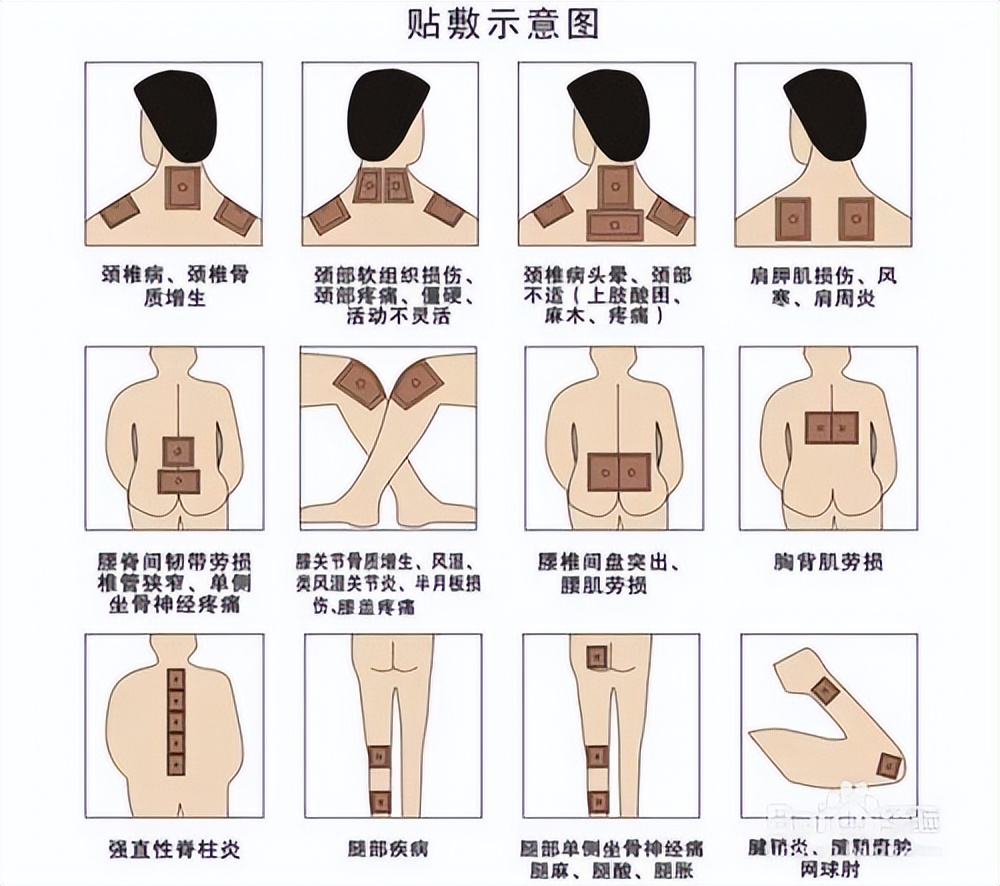 随手一贴就完事？贴膏药勿随意