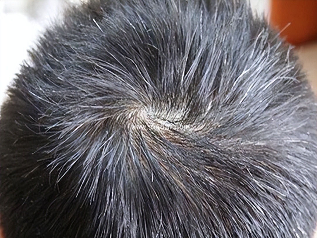 白发不可怕重要的是要选对方法,白发要吃什么才会转黑