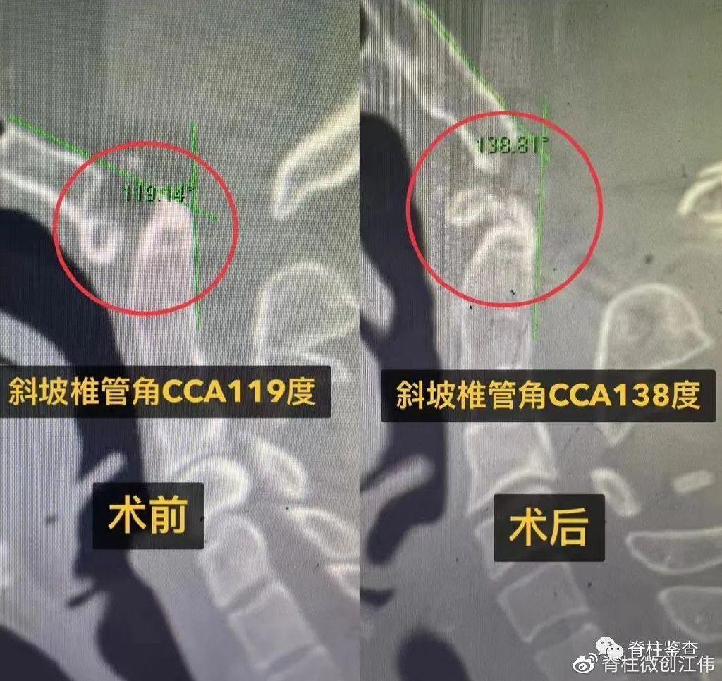 颅底凹陷症齿状突半脱位,颅底手术新突破