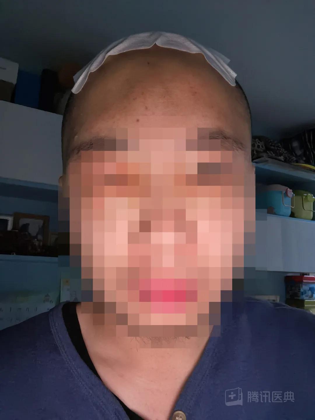 开颅手术后被掀开的头皮多久恢复,开颅手术掀开头皮头皮怎么恢复的