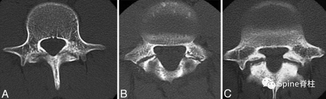 轻度峡部裂和重度峡部裂的区别,真性峡部裂和假性峡部裂