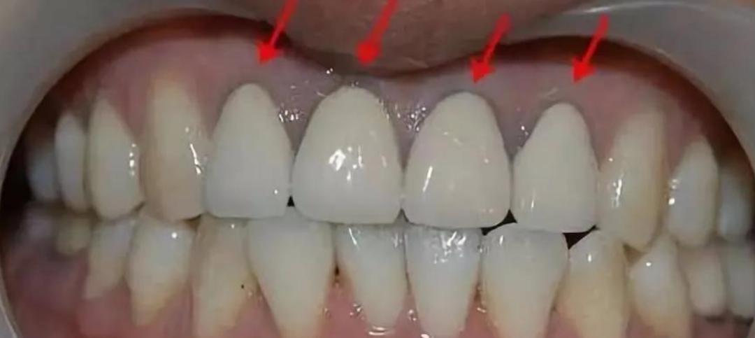 缺牙后哪种补牙性价比高,缺牙想补牙去哪里比较划算